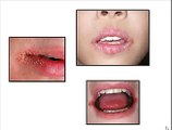 Angular cheilitis free forever -- discover Angular cheilitis free forever