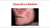 Tratamiento De Rosacea - Rosacea Cara, Como Se Cura La Rosacea
