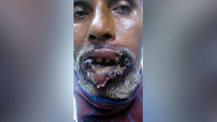 Gore : Il se fait manger sa bouche par des asticots !