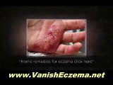 Natural Skin Care for Psoriasis, Eczema and Rosacea