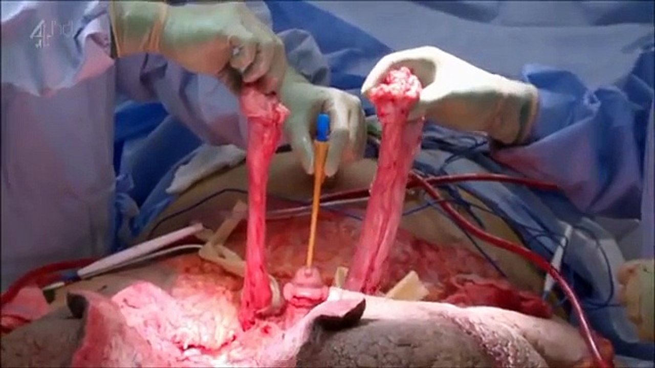 Medical Videos_ man with 132 pound Tumor in his testicles