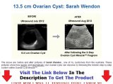 Ovarian Cyst Miracle Don't Buy Unitl You Watch This Bonus   Discount