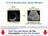 Ovarian Cyst Miracle Don't Buy Unitl You Watch This Bonus + Discount