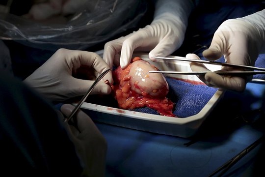 Marseille : une greffe de rein entre deux donneurs vivants