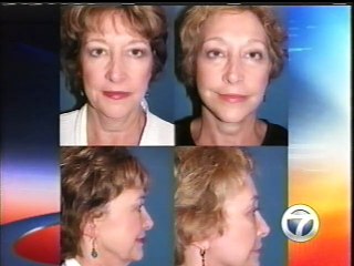 Little Rock Eyelid Lift