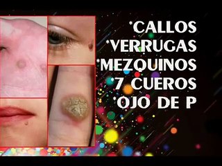 Elimina las verrugas con liquido Maravilla