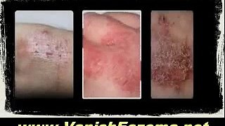 Overview of The 14 Days Eczema Cure