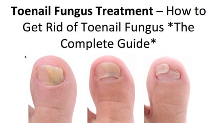 How to Get Rid Of Toenail Fungus Using 3 Simple Home Treatments