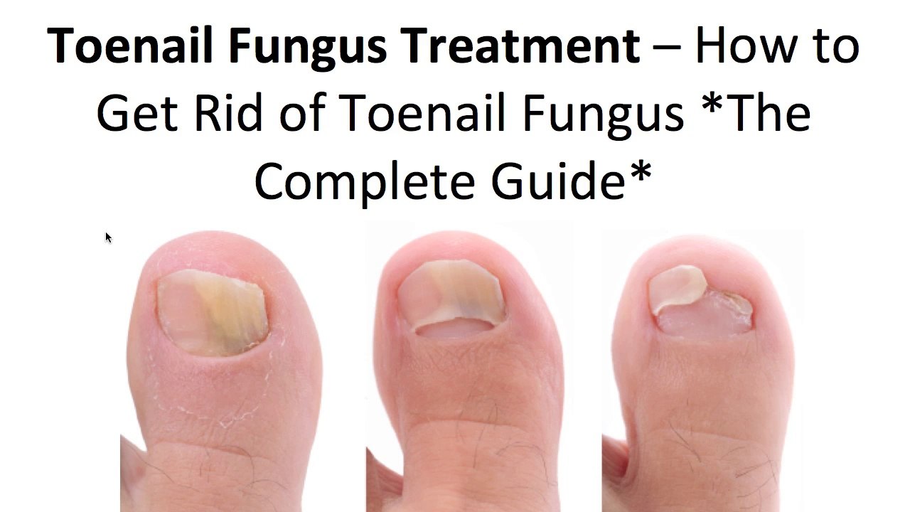 How to Get Rid Of Toenail Fungus Using 3 Simple Home Treatments