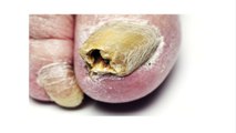How To Cure Toenail Fungus: Get Rid Of Your Fungal Toenails In Weeks