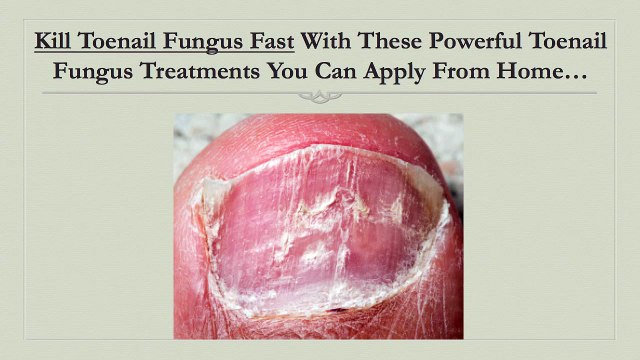 Kill Toenail Fungus: Home Toenail Fungus Treatments That Provide Amazing Results