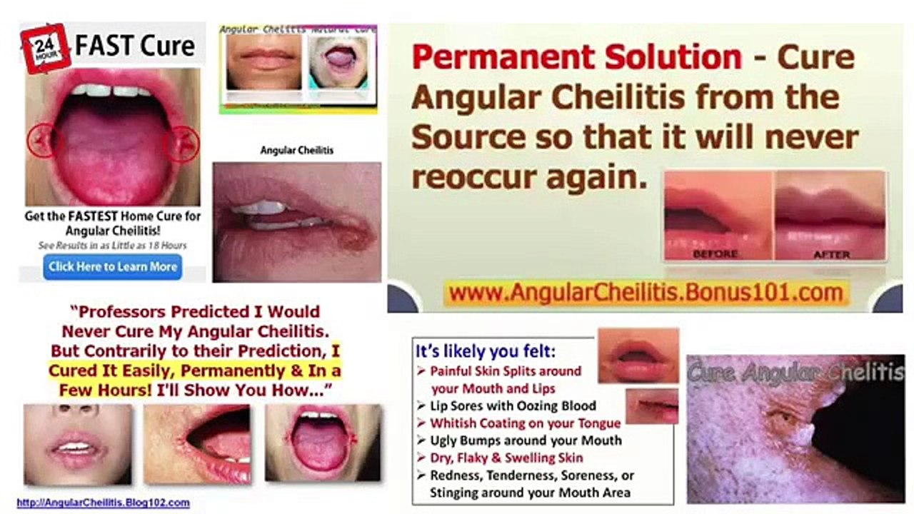 Buy Angular Cheilitis Overnight Cure you are looking for