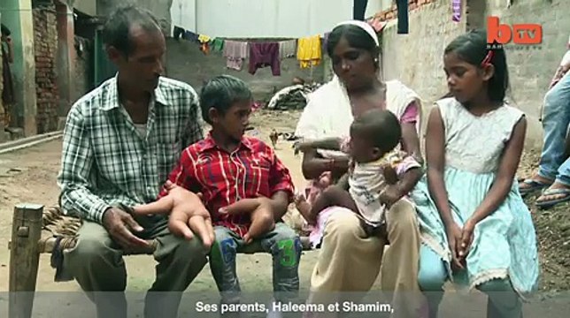 Un enfant de 8 ans aux mains géantes en Inde