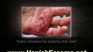 Learn How to Beat Eczema