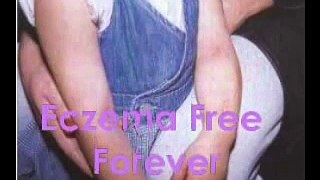 Eczema Free Forever - Home Remedies for Eczema