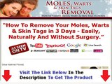 Moles Warts & Skin Tags Removal Pdf Free + DISCOUNT + BONUS