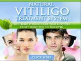 Natural Vitiligo Treatment System - Natural Vitiligo Treatment System Reviews