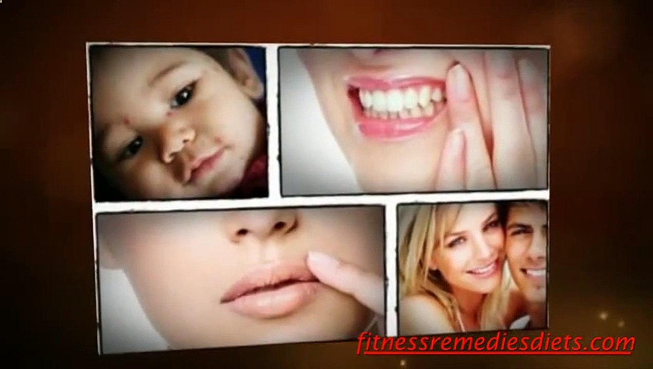 Is Herpes A Virus
