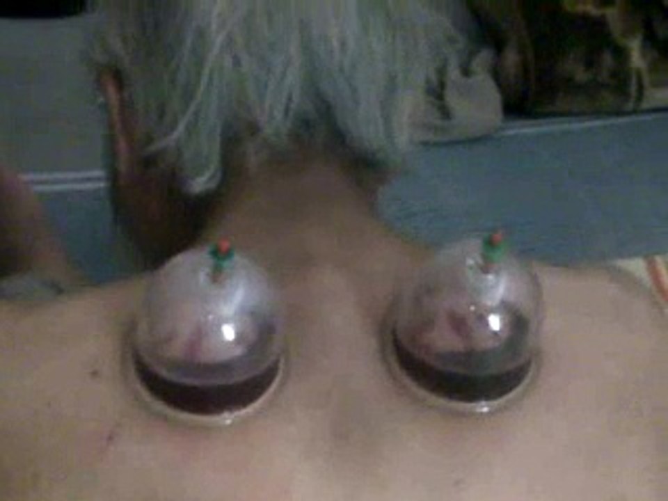 Hijama for suger patient