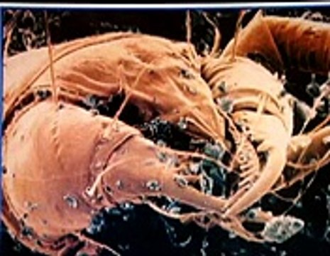 Allergies-Hypersensitivity Type 1