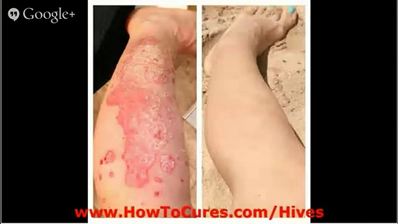 Get Rid Of Hives - Cures For Allieviating Urticaria Pigmentosa - Get Rid Of Hives