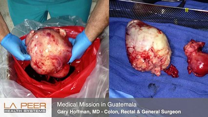 What Causes Anal Fistulas