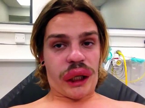 Bug sting : better than botox on lips