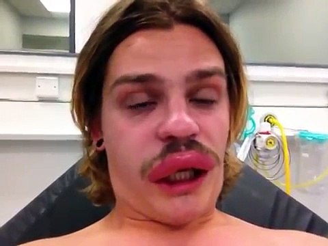 Quand on se fait piquer à la lèvre par un insecte