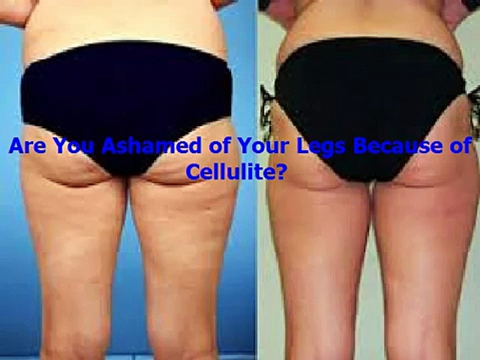 How to Reduce Cellulite on Thighs and Buttocks With Truth About Cellulite
