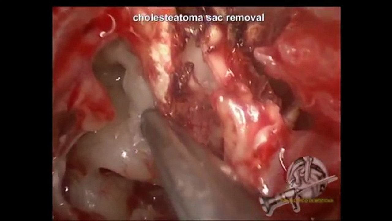 ENT Middle-Ear