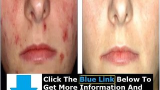 Acne Free In 3 Days Chris Gibson Free Download + Acne Free In 3 Days Pdf