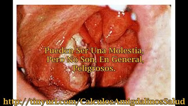 Calculos Amigdalinos Remedios Naturales - Tratamiento Para Caseum Amigdalar