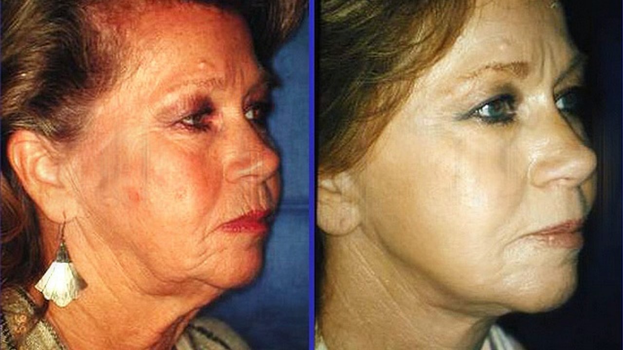 Face Lift Procedure