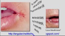 Angular Cheilitis Free Forever - How to Cure Angular Cheilitis Naturally & Permanently in 12 Hours