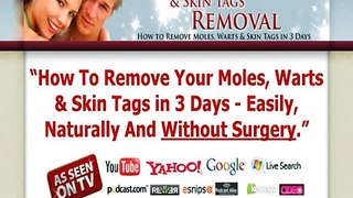 Moles, warts and skin tags removal home remedy in 3 Days