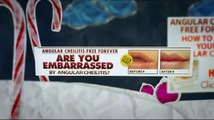 What Is Angular Cheilitis Free Forever