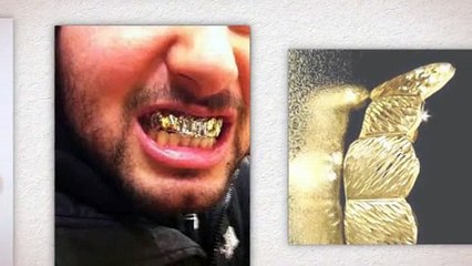 Gold Teeth Crowning