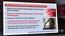 Pearly Penile Papules Removal Review   Pearly Penile Papules Removal Download