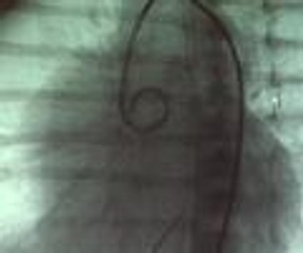 Salih Bebek en küçük vaka olarak literatüre girdi