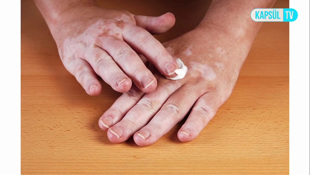 Vitiligonun Belirtileri Nelerdir?