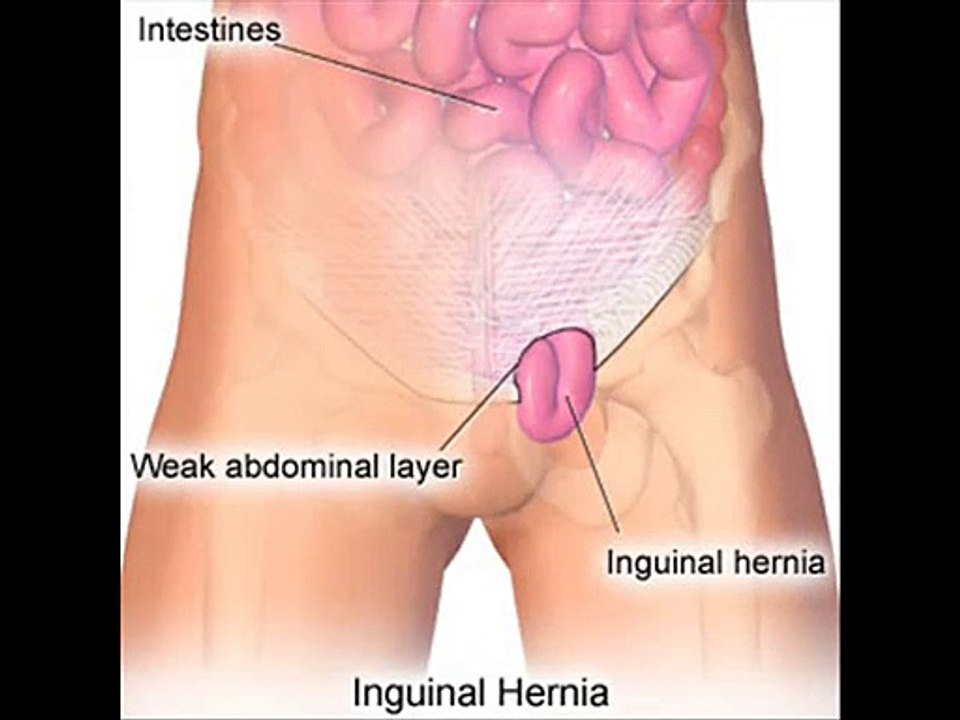 obat hernia