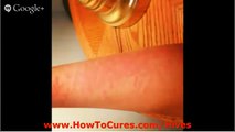 How To Get Rid Of Hives - Cures For Soothing Solar Urticaria - How To Get Rid Of Hives