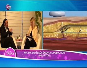 Op. Dr. Deniz Küçükkaya - Liposuction (Sağlıklı Yaşam - Tv360)