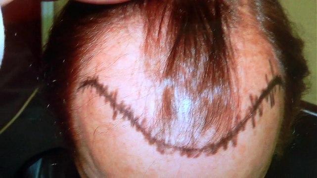 Bald Hairline Hair Loss Transplant Surgery Result Dr. Diep mhtaclinic.com 1 Year Follow Up