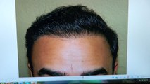 Man Hair Loss Transplant Restoration Surgery Dr. Diep www.mhtaclinic.com