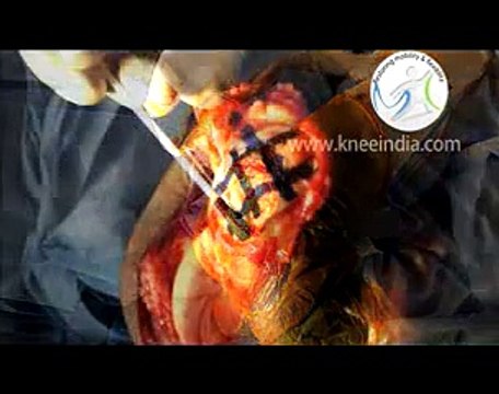 Stem Cell Treatment of Cartilage Injuries India