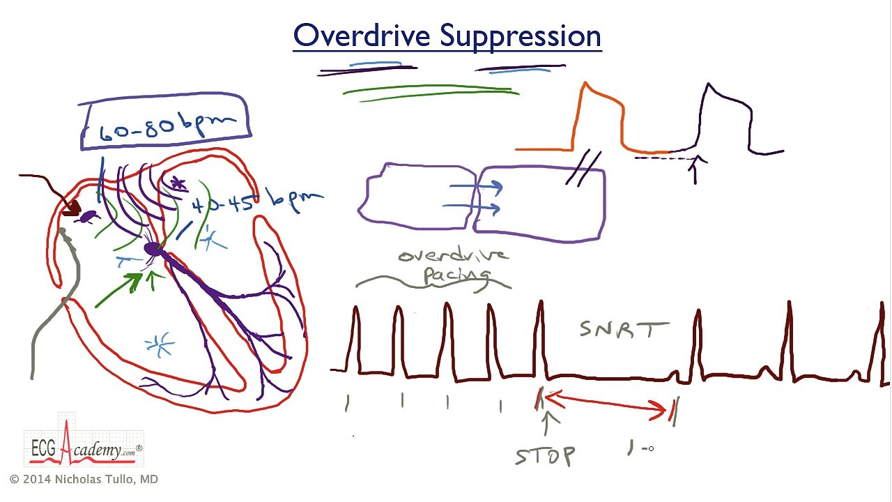3. TachyBrady Syndrome video Dailymotion