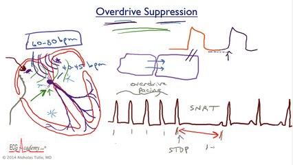 3. Tachy-Brady Syndrome