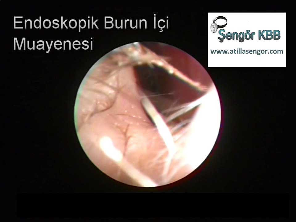 Çocuklarda Sinüzit Muayenesi - Endoscopic diagnosis of sinusitis in children