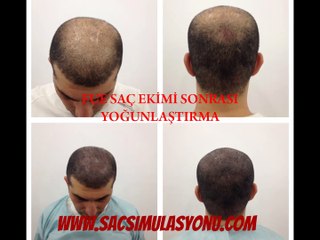 Saç Simülasyonu - HFS Hair Follicles Simulation - Hair Micropigmentation